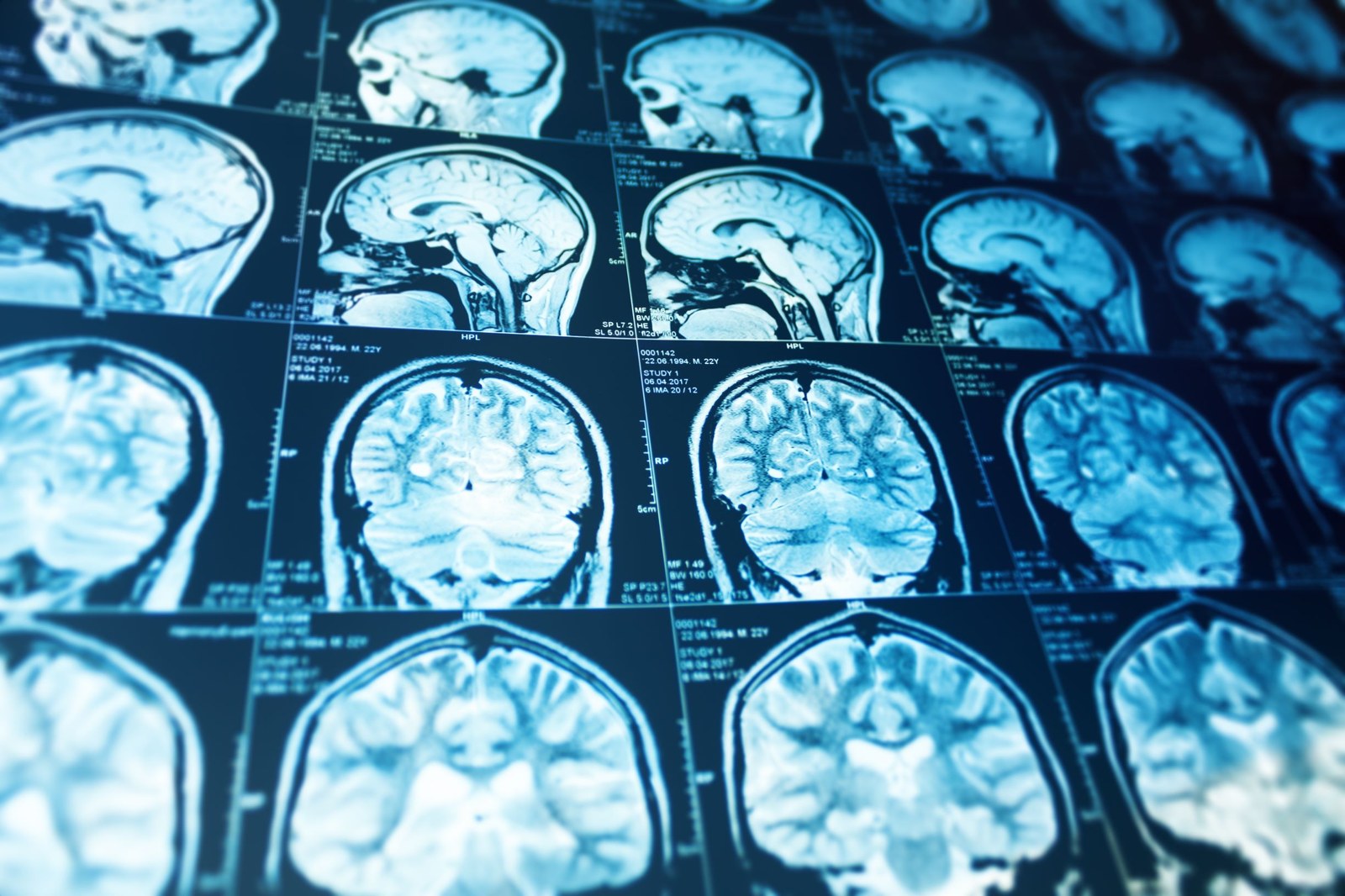 A brain MRI.