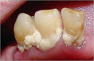 Heavy plaque